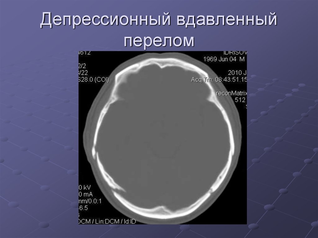 Импрессионный перелом. Импрессионный перелом черепа на кт. Импрессионный вдавленный перелом свода черепа. Импрессионный перелом теменной кости. Депрессионный вдавленный перелом.