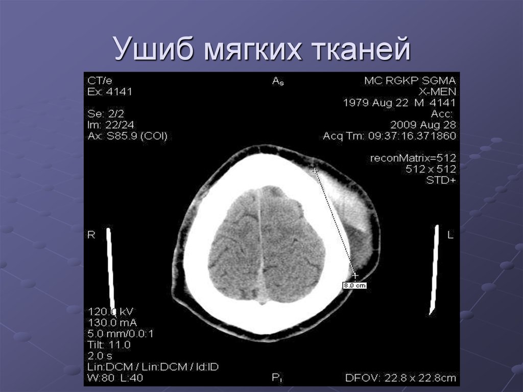 Мягкие ткани головы. Головной мозг гематома мягких тканей на кт. Гематома мягких тканей на кт. Ушиб мягких тканей головы на кт. Ушиб мягких тканей головного мозга на кт.