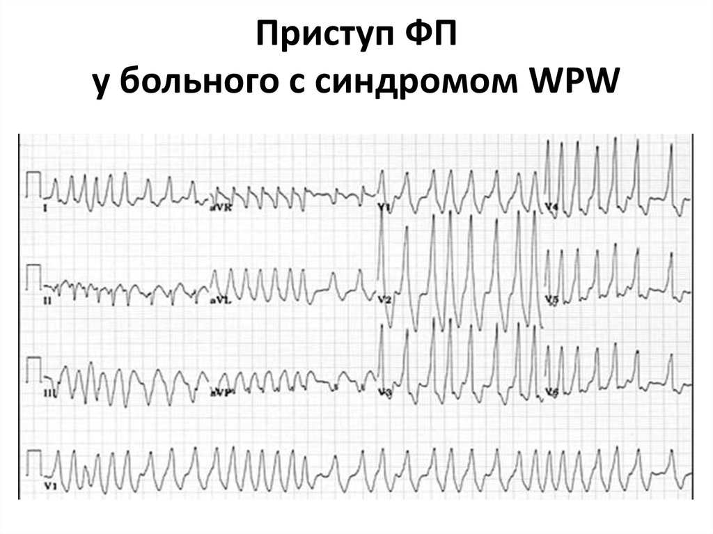 Wpw синдром на экг картинки