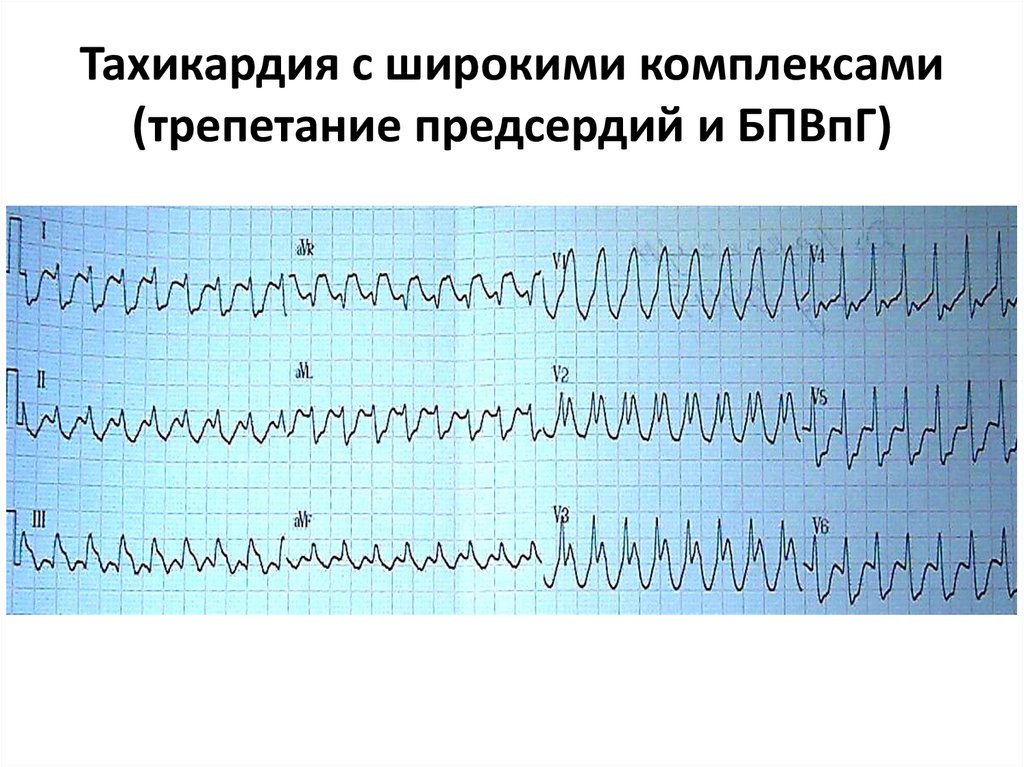 Тахикардия