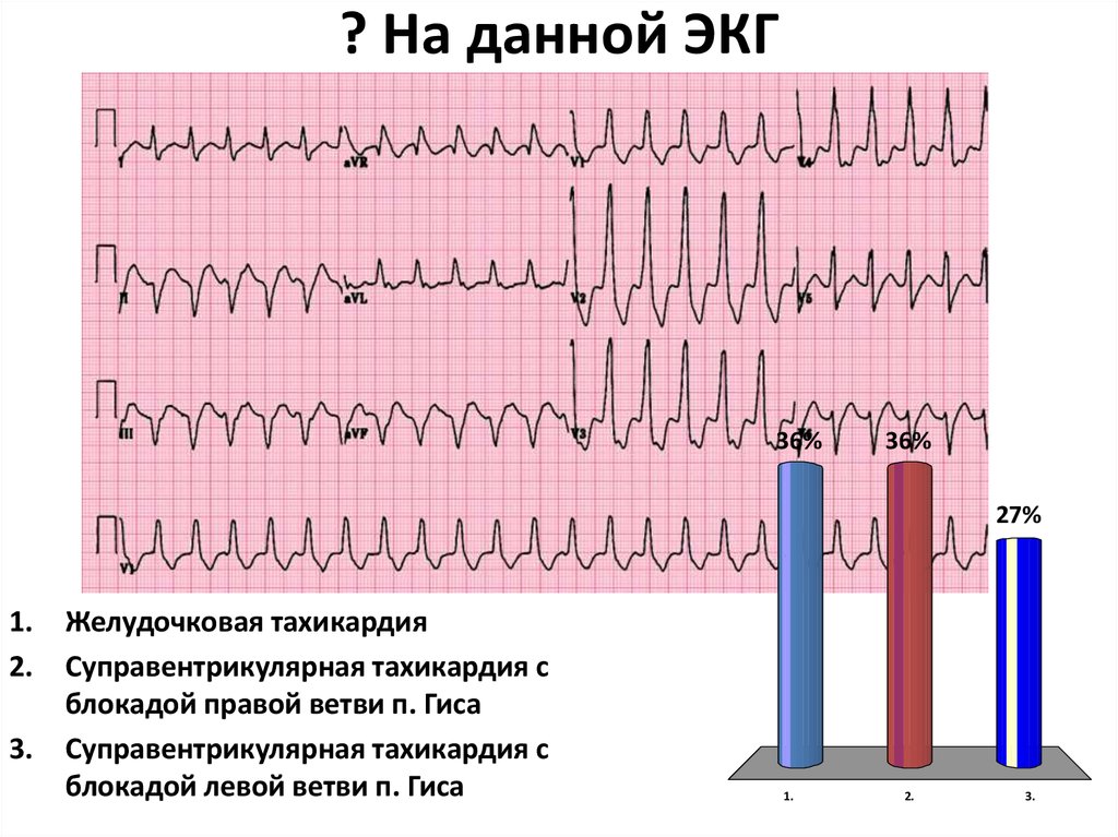 Желудочковая тахикардия