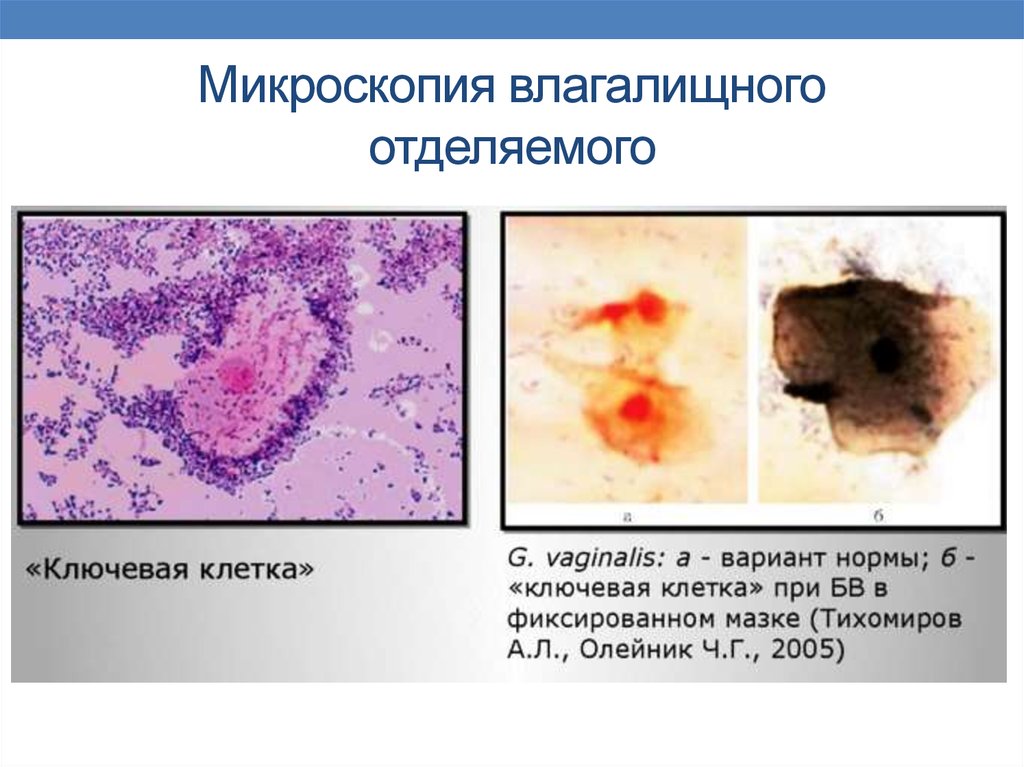 Ключевые клетки в мазке на флору. Бактериальный вагиноз микроскопия мазка. Ключевые клетки микроскопия. Бактериальный вагиноз ключевые клетки. Ключевые клетки в мазке микроскопия.