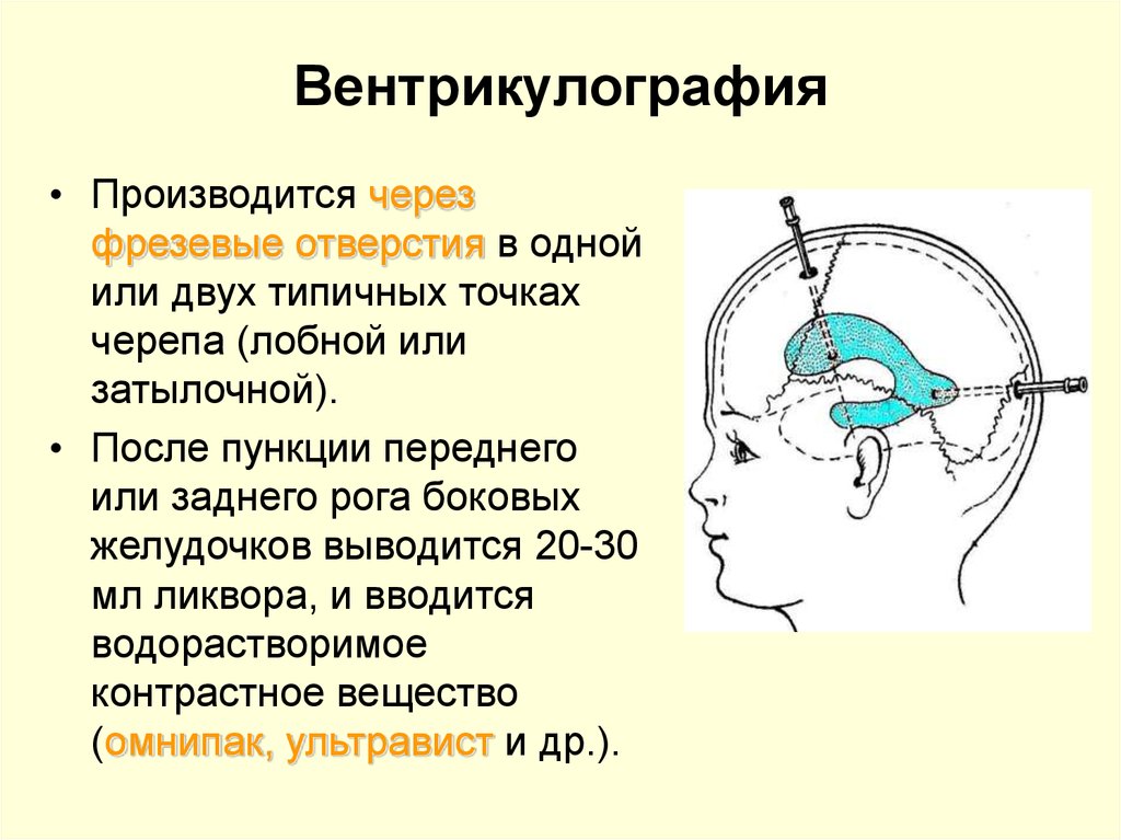 Как делают пункцию мозга. Контрастная вентрикулография. Вентрикулография желудочков мозга. Рентгеноконтрастная вентрикулография.