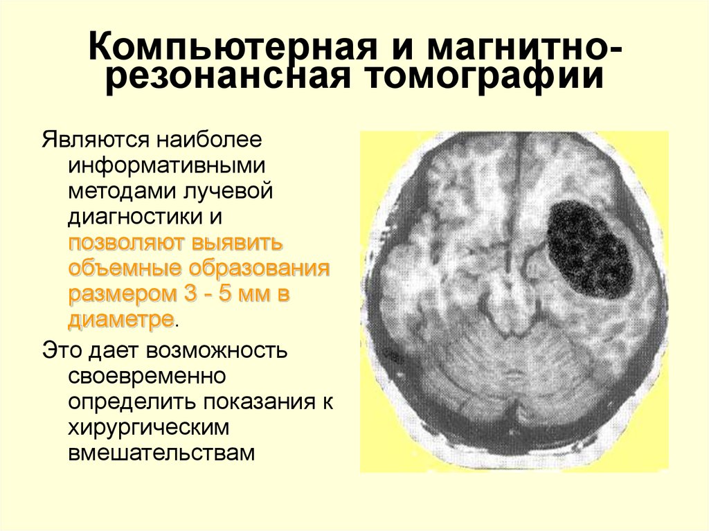 Симптомы онкологии головного мозга. Опухоль головного мозга симптомы. Опухоль головного мозга стадии. Проявление опухоли головного мозга. Степени опухолей головного мозга.