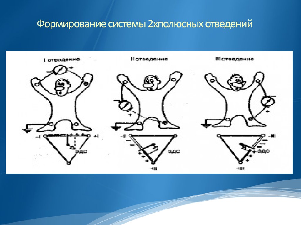 Дополнительные отведения экг презентация