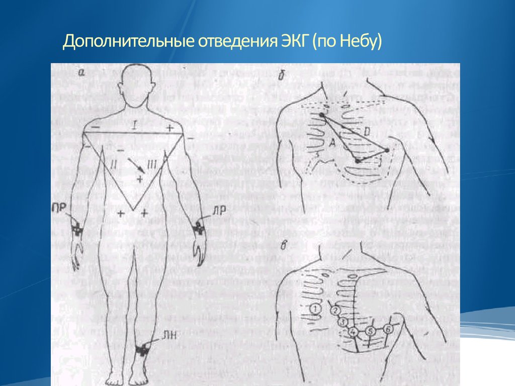 Отведения экг. Дополнительные отведения v7-v9. Электроды v7 v8 v9. Дополнительные отведения ЭКГ по Слопаку. Дополнительные электроды на ЭКГ.