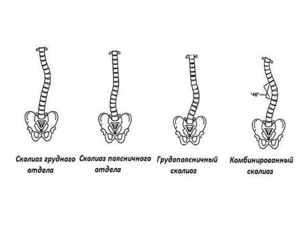 Сколиоз какому. Сколиоз по месту локализации. Сколиоз позвоночника схема. Сколиоз по локализации искривления позвоночника. Сколиоз 1 степени схема.