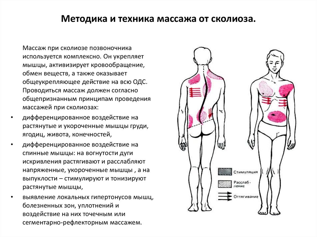 Миостимуляция при сколиозе схема