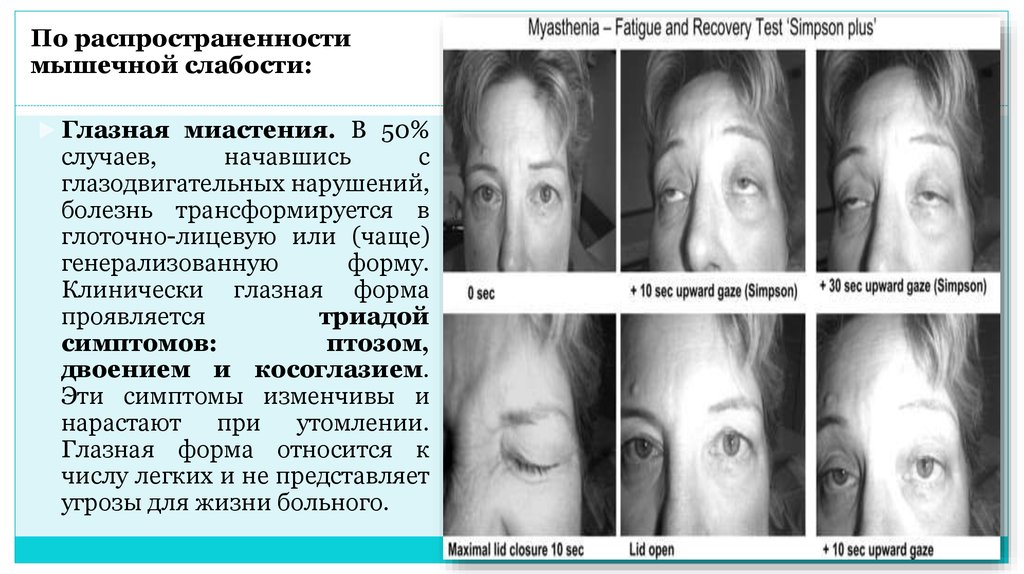 Центральная слабость. Миастения глазная форма симптомы. Миастения глазная форма неврология. Миастения глоточно-лицевая форма.