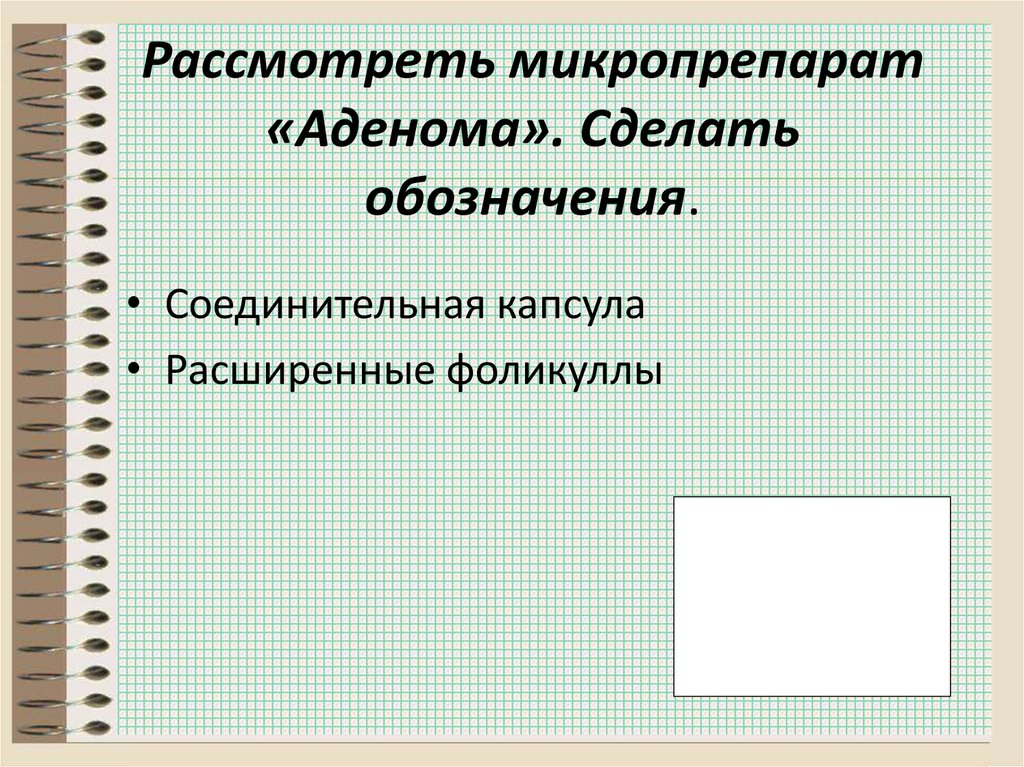 Рассмотреть микропрепарат «Аденома». Сделать обозначения.