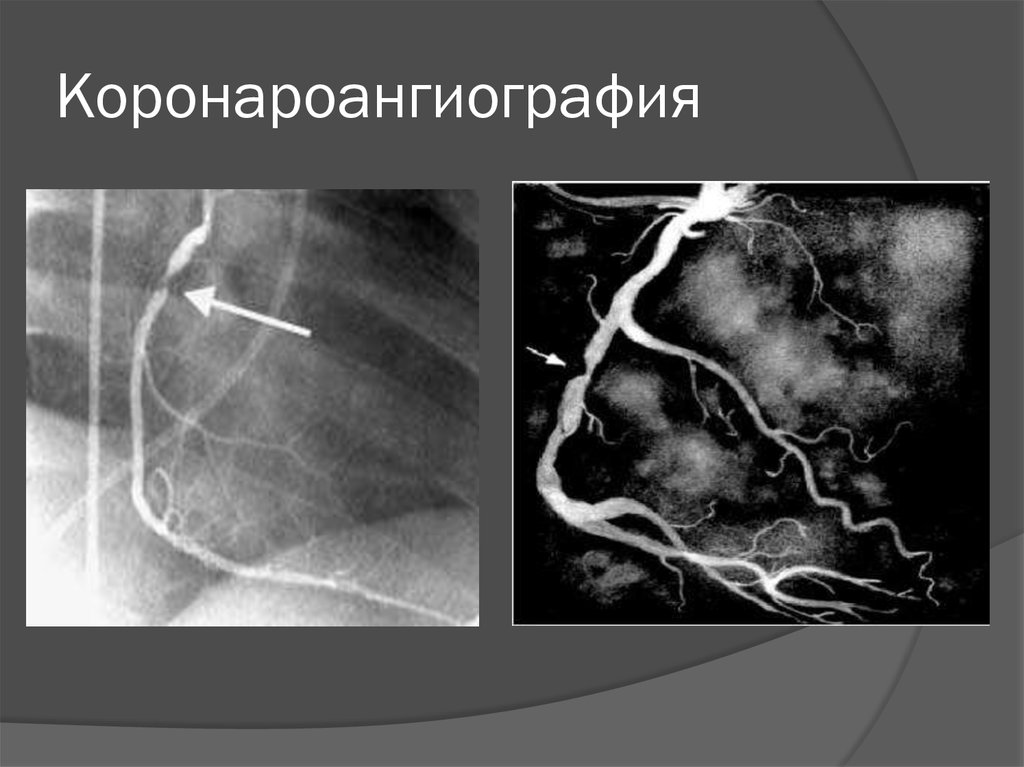 Коронография. Коронароангиография методика. Коронароангиография метод исследования. Коронароангиография при ГКМП. Селективная коронароангиография.