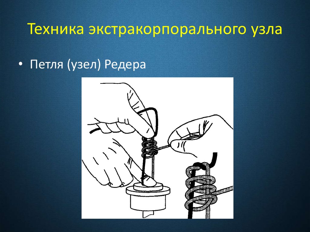 Техника экстракорпорального узла