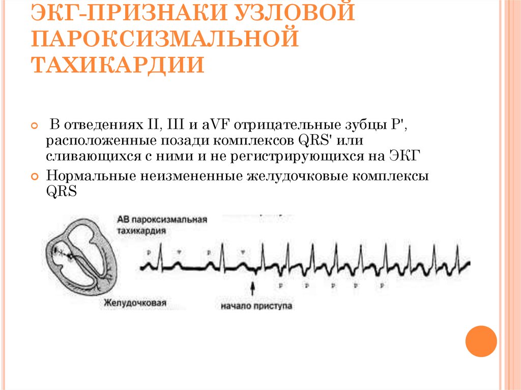 Тахикардия симптомы. Атриовентрикулярная Узловая пароксизмальная тахикардия ЭКГ. АВ Узловая пароксизмальная тахикардия на ЭКГ. Пароксизмальная тахикардия ЭКГ признаки. Узловая пароксизмальная тахикардия на ЭКГ.