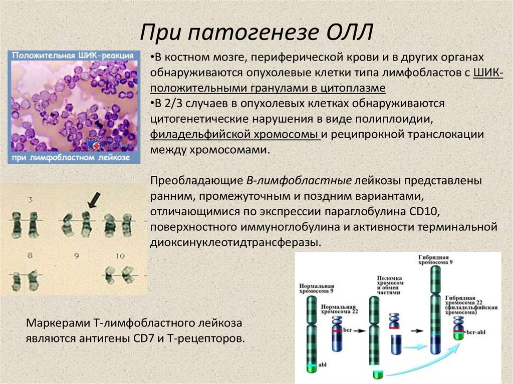 Острый лимфобластный лейкоз презентация