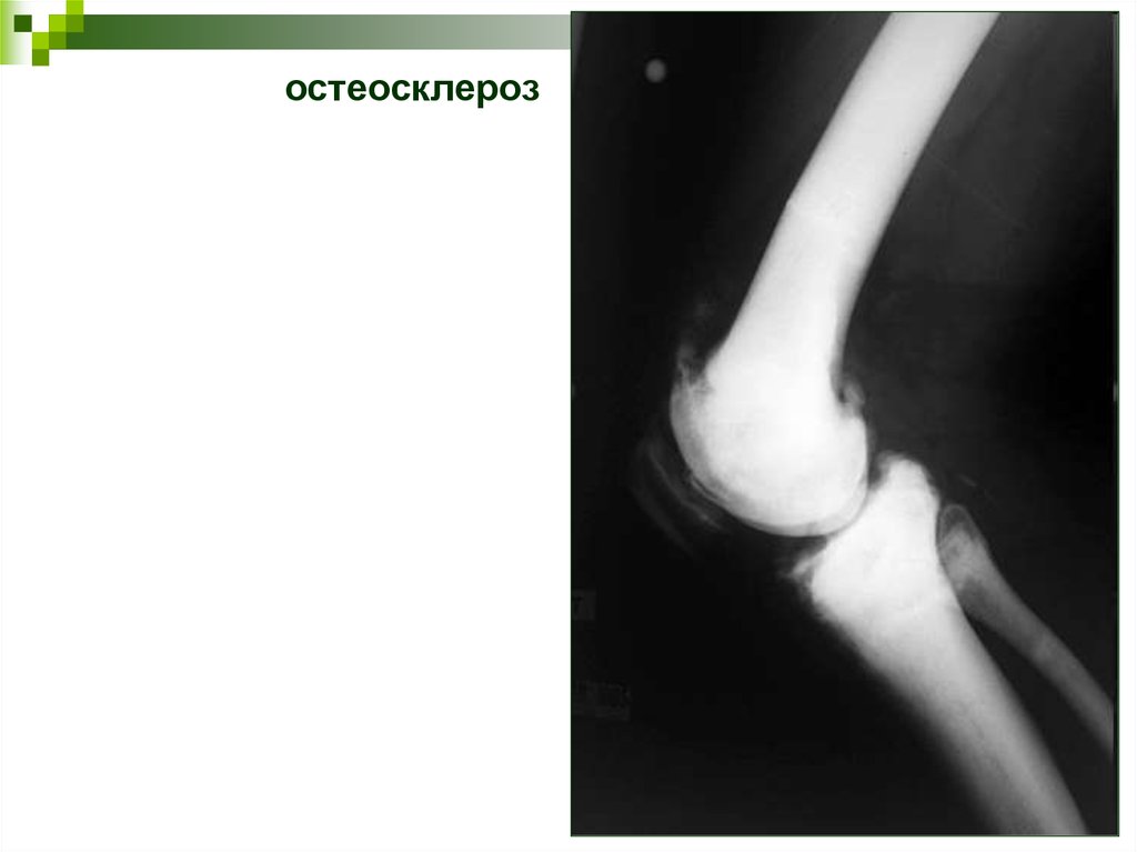 Болезнь костей. Остеосклероз плечевой кости на рентгене. Пятнистый остеосклероз. Эндостальный остеосклероз. Посттравматический остеосклероз.