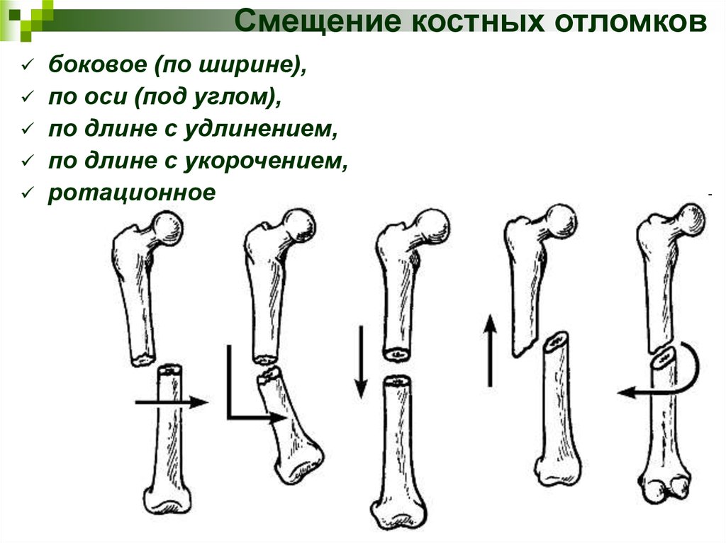 Ширина кости. Характер смещения отломков при переломах кости. Краниальное смещение отломков. Смещение костных отломков по длине. Смещение костных отломков по ширине.