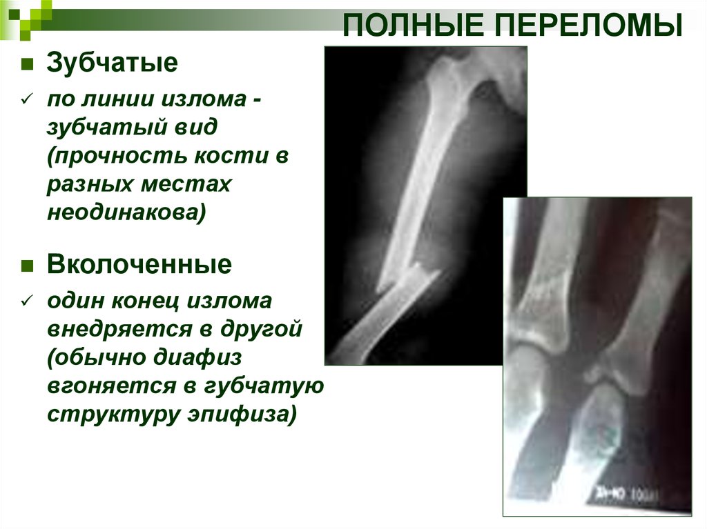 Клиническая картина переломов