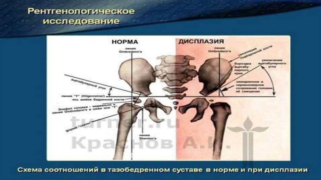 Схема хильгенрейнера тазобедренных суставов у детей