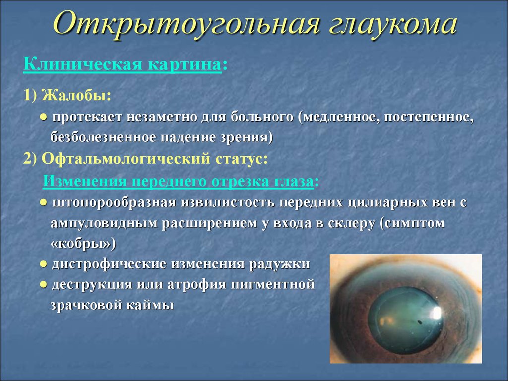 Что нельзя делать при глаукоме. Открытоугольная глаукома симптомы. Первичная закрытоугольная глаукома. Для открытоугольной глаукомы характерно.