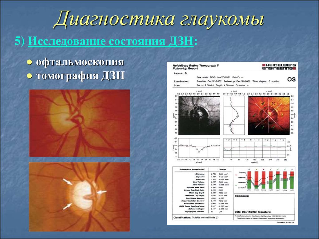 Офтальмоскопия диска зрительного нерва. Диагностика глаукомы. Офтальмоскопия при глаукоме. Классификация глаукомы