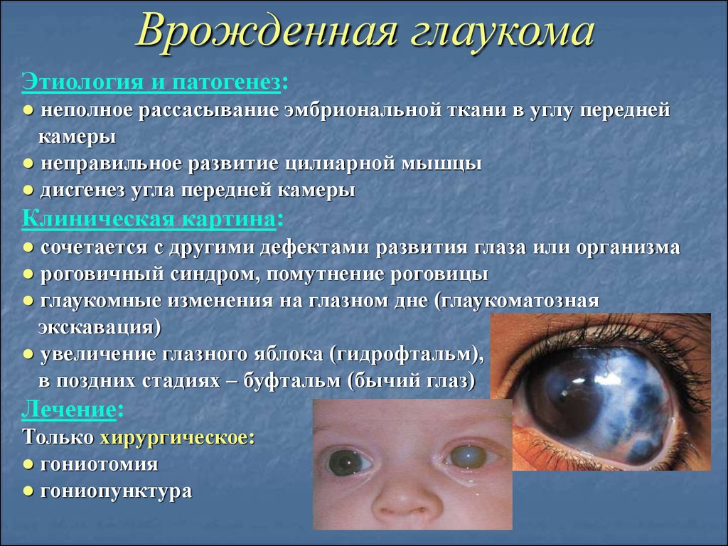 Причины заболевания зрения. Врожденная глаукома буфтальм. Врожденные заболевания глаз.