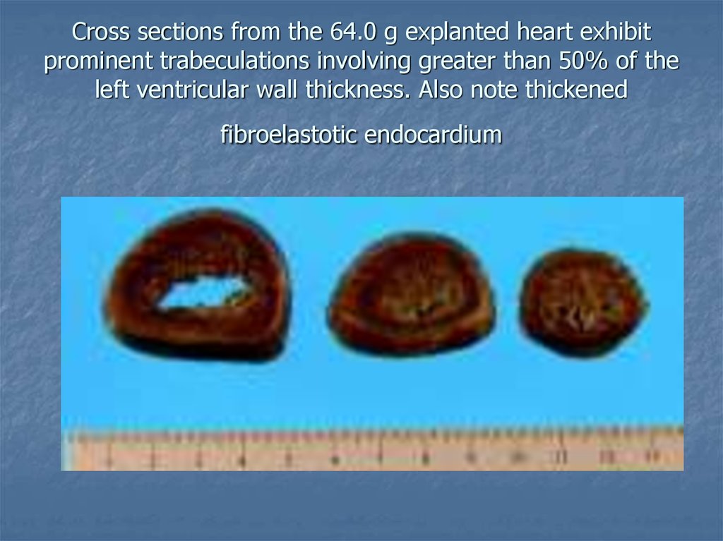 Cross sections from the 64.0 g explanted heart exhibit prominent trabeculations involving greater than 50% of the left ventricular wall thickness. Also note thickened fibroelastotic endocardium