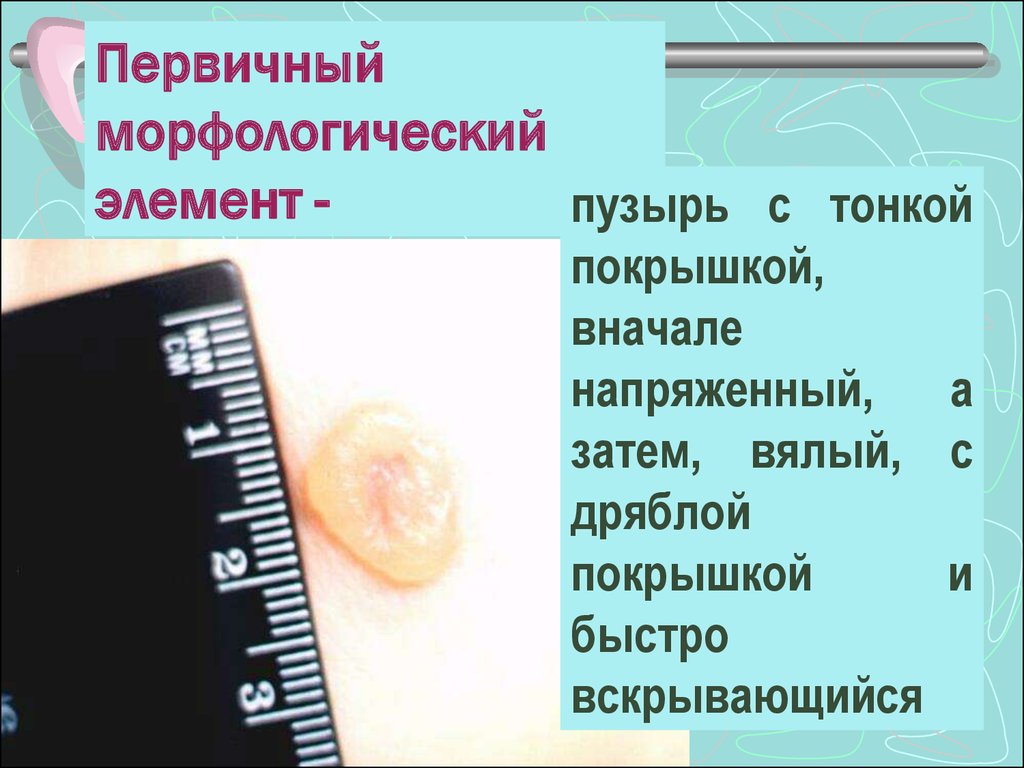 Волдырь элемент. Первичные морфологические элементы. Волдырь первичный морфологический элемент. Пузырь морфологический элемент. Пузырек морфологический элемент.