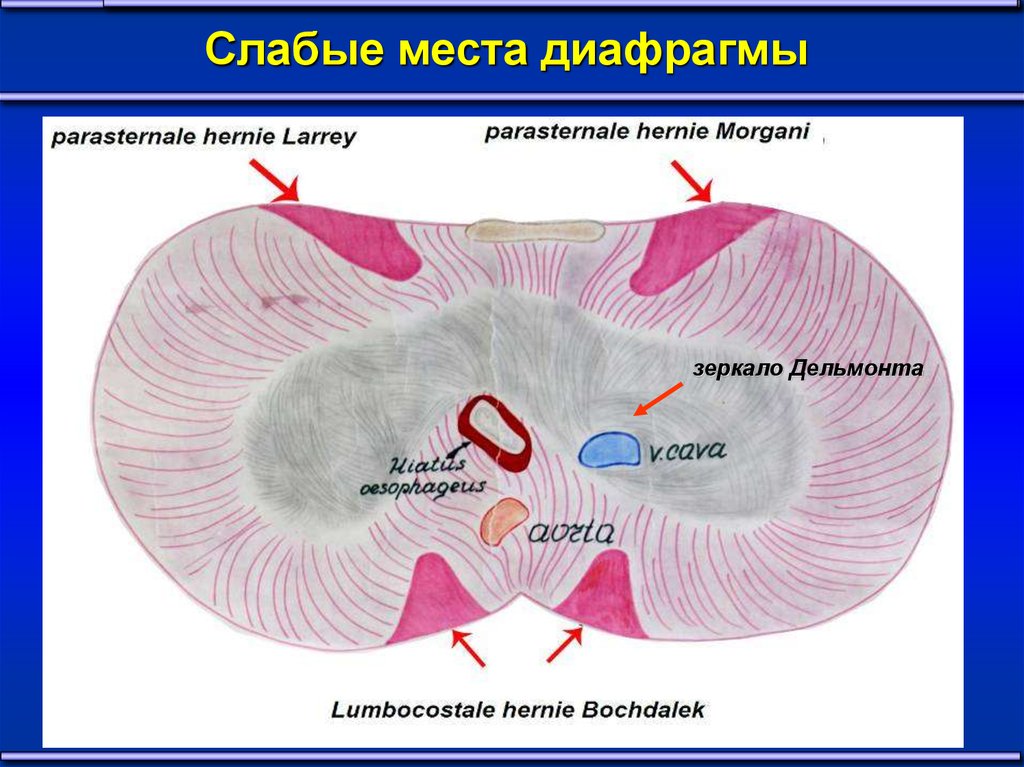 Грыжа бохдалека. Пояснично реберный треугольник диафрагмы. Треугольник Морганьи и Ларрея. Грыжи Ларрея Морганьи и Бохдалека. Грыжа Ларрея Морганьи диафрагмы.