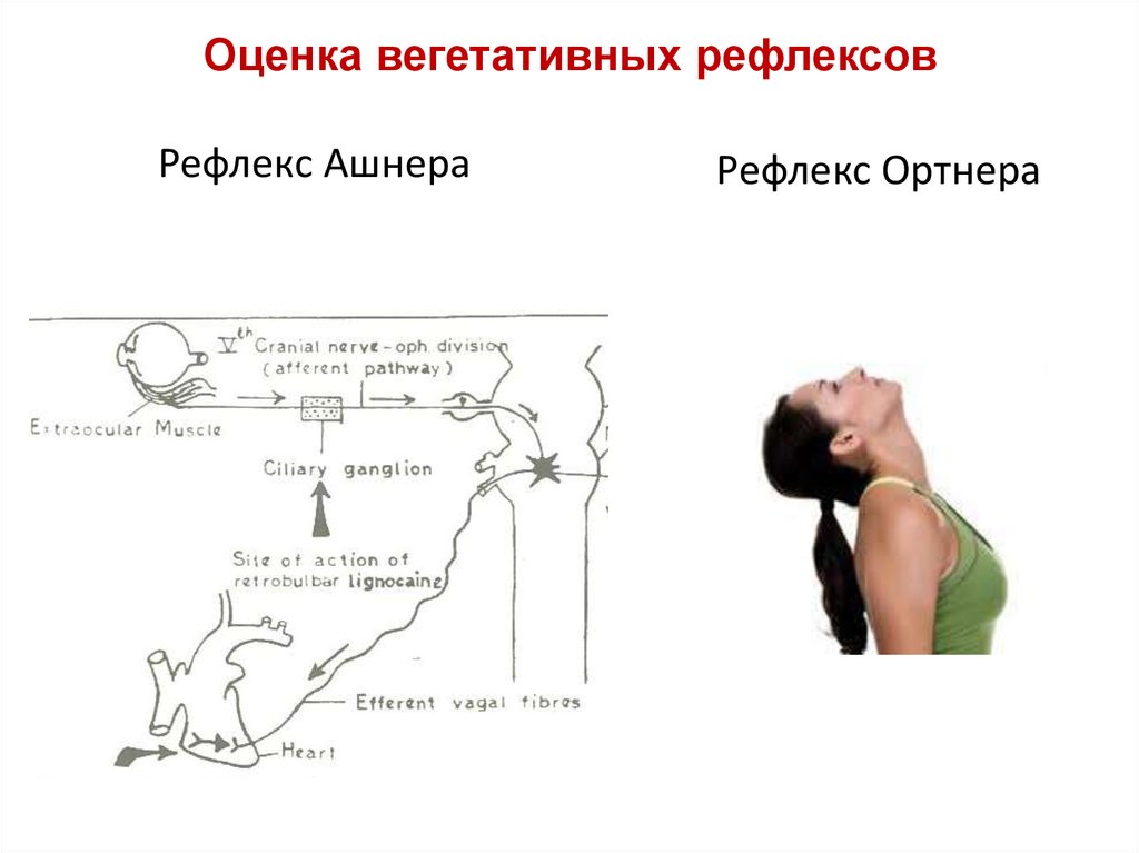 Схема рефлекторной дуги глазосердечного рефлекса