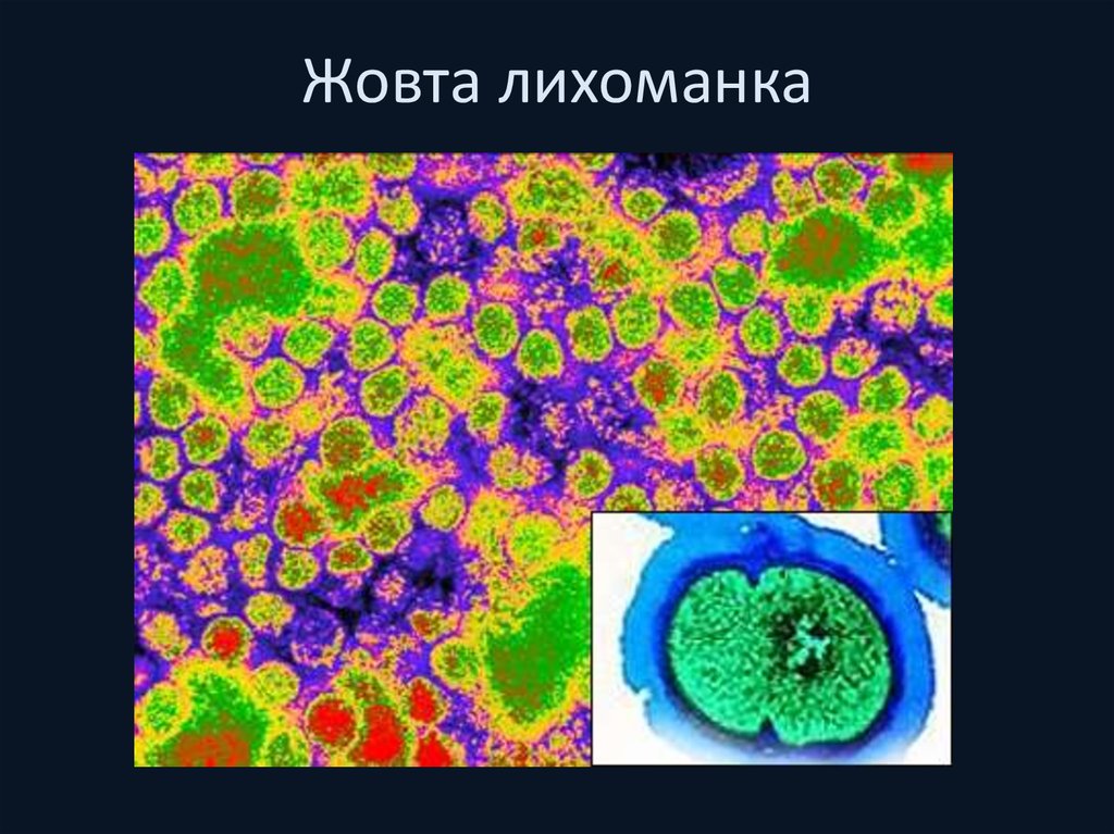 Жовта лихоманка