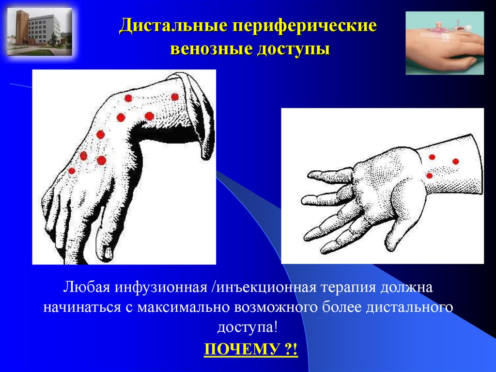 Периферическая вена. Периферический венозный доступ. Центральные и периферические вены.