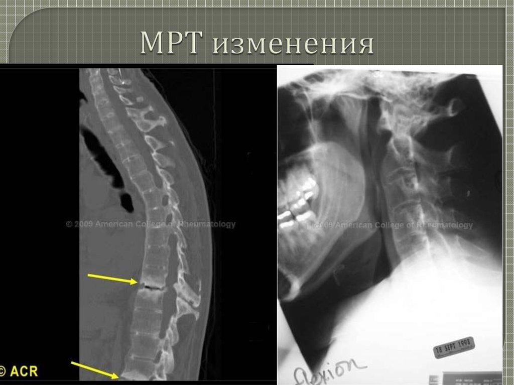 Анкилозирующий спондилоартрит презентация