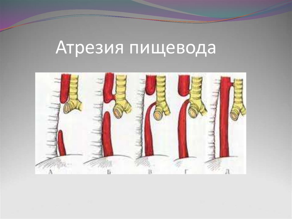 Атрезия пищевода у детей презентация