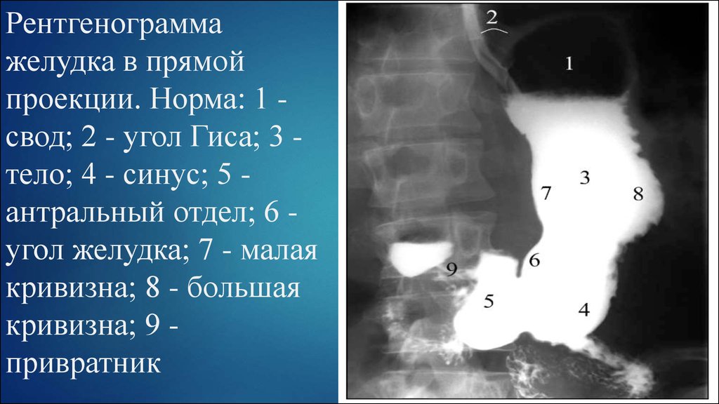 Рак антрального отдела. Рентген анатомия желудка в норме. Рентгенограмма желудка в прямой проекции. Отделы желудка на рентгенограмме.