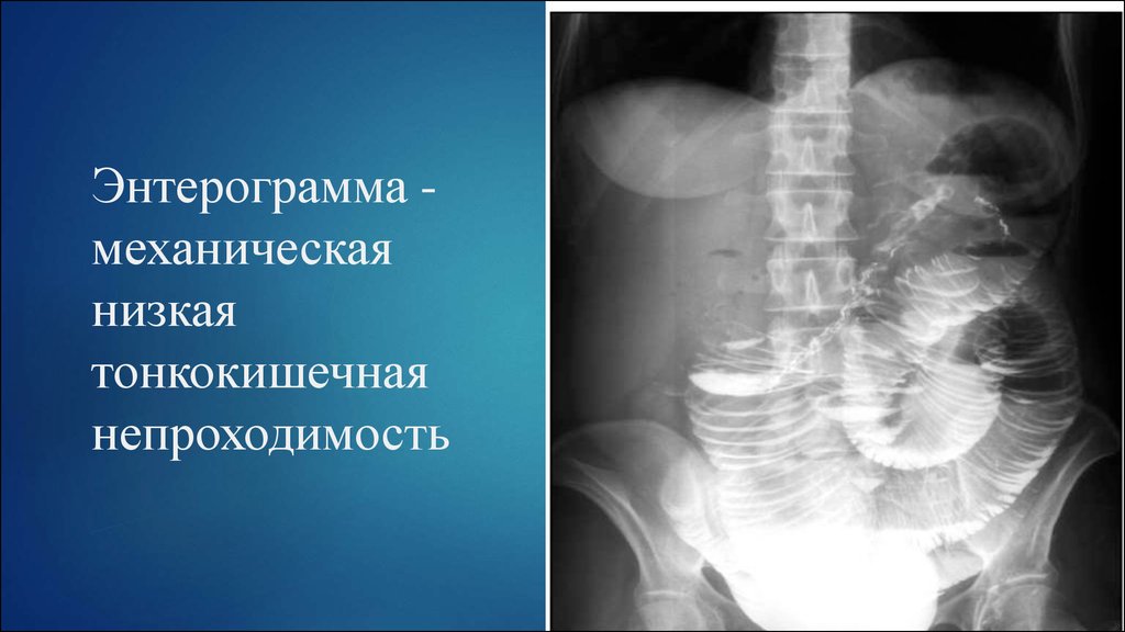 Тонкокишечная непроходимость