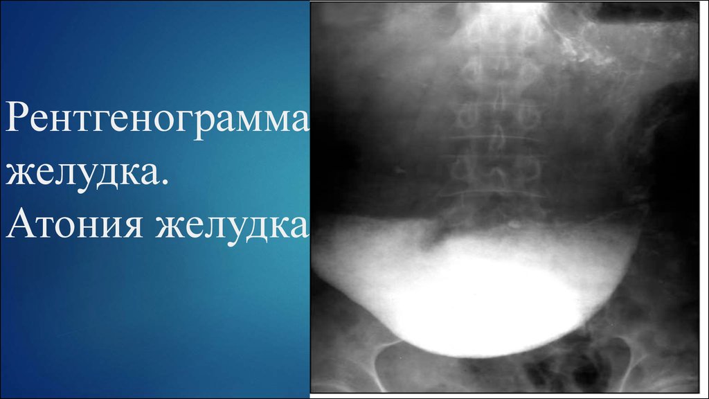 Гипотония и атония. Гипотония желудка рентген. Атония желудка рентген. Атония (гипотония) желудка рентген.