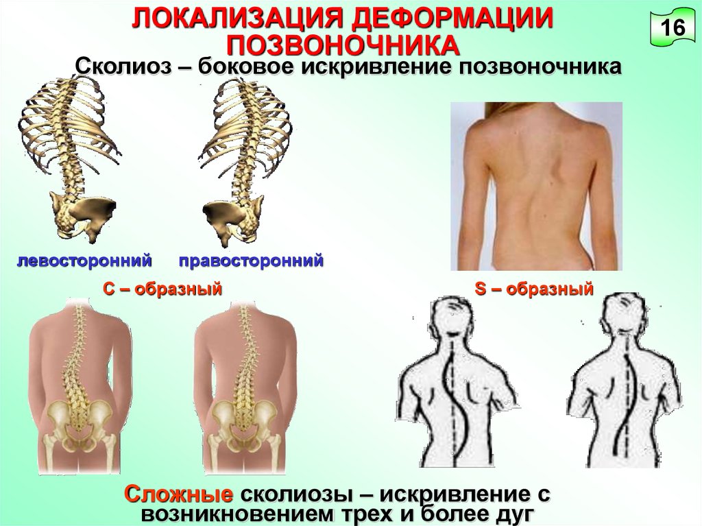 Левосторонний сколиоз. Правосторонний s образный сколиоз. Сколиоз позвоночника s образный. Сколиоз боковое искривление позвоночника. С образное искривление позвоночника.