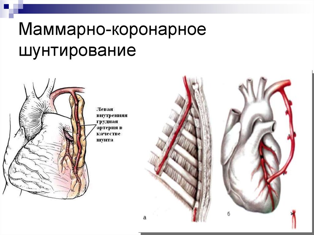 Схема аортокоронарного шунтирования