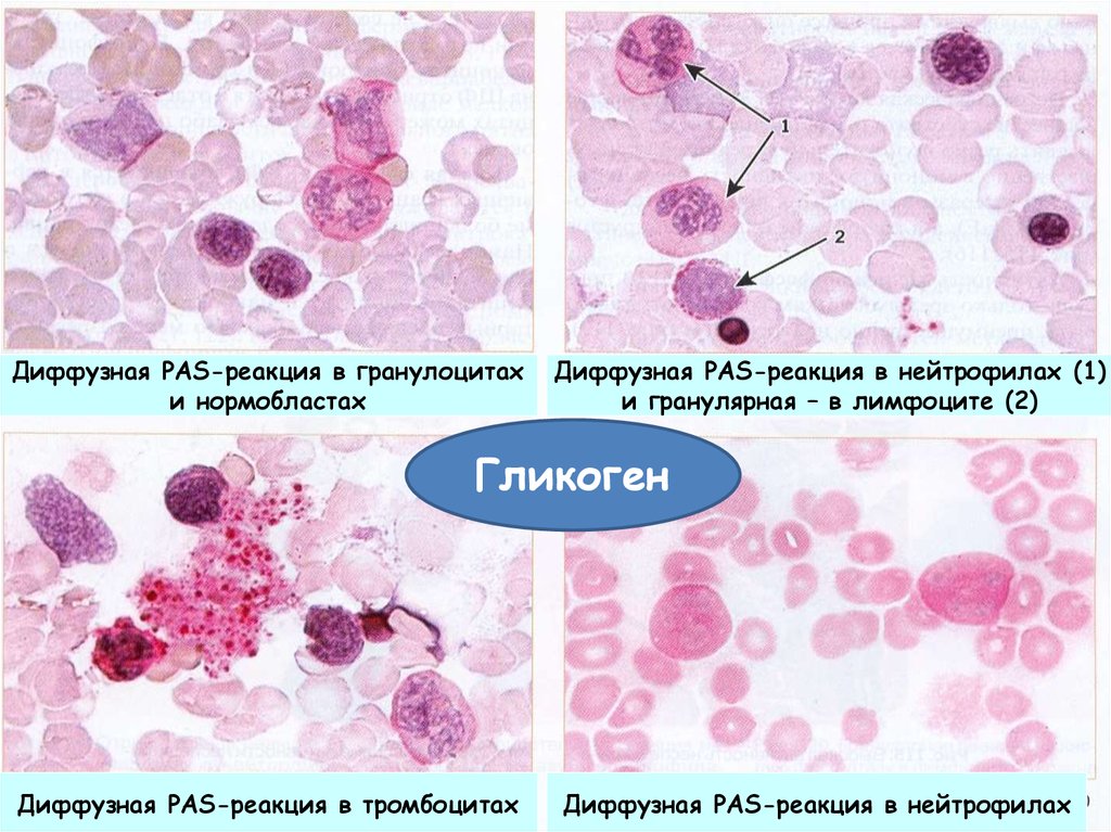 Слабый диффузный. Pas реакция положительная. Реакция на гликоген при лейкозах. Реакция на гликоген положительная. Гранулярная pas-реакция.