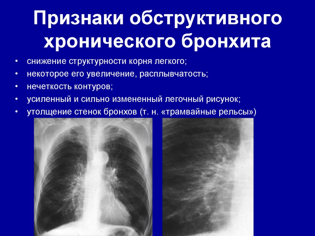 Презентация острый обструктивный бронхит у детей