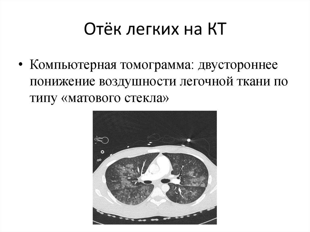 Поствоспалительные изменения в легких на кт