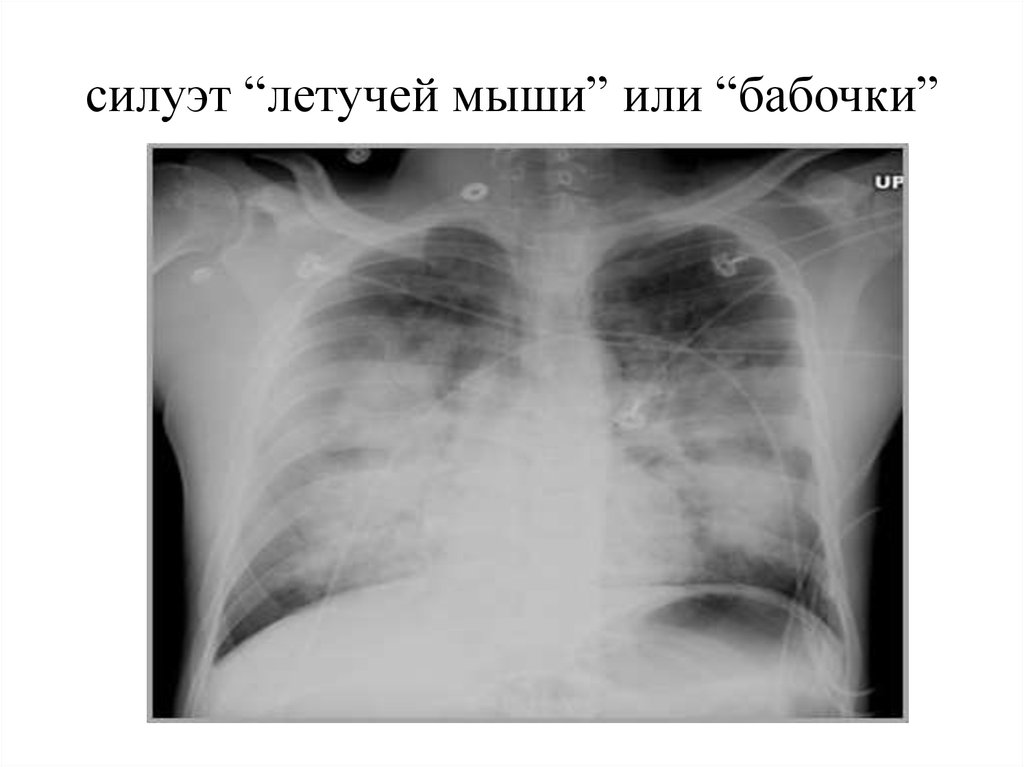 Отек легких рентгенологическая картина