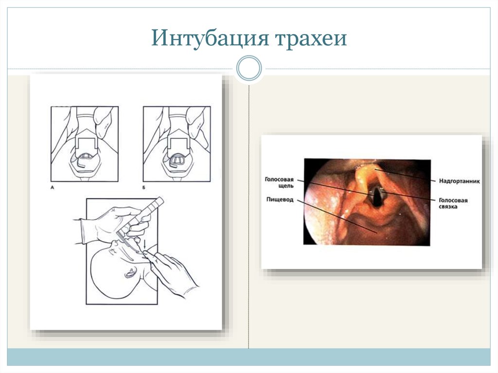 Интубация трахеи презентация