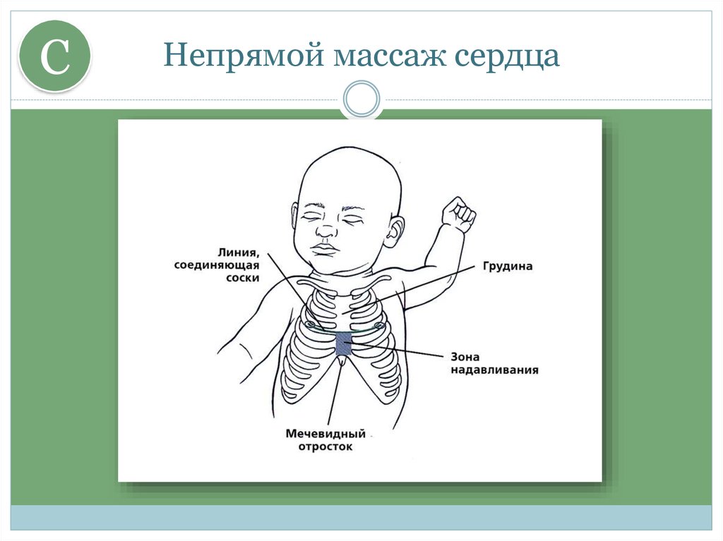 Положение рук при непрямом массаже сердца фото