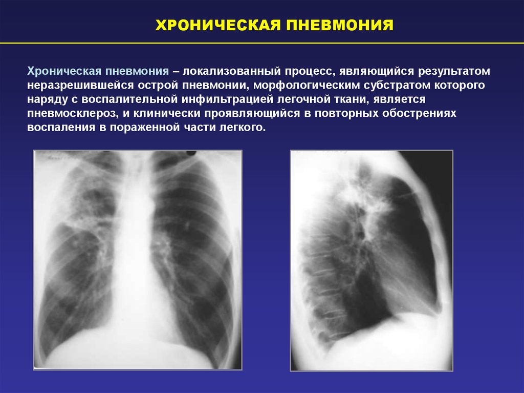 Острая инфекция легких. Рентгенологические признаки хронической пневмонии. Хроническая пневмония рентген. Хроническая неспецифическая пневмония. Рентген признаки пневмонии.