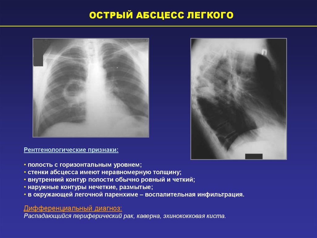 Полость проявление. Хронический абсцесс легкого рентгенограмма. Рентген при абсцессе легкого. Рентгеновские снимки при абсцессе легкого. При остром абсцессе легкого рентген.