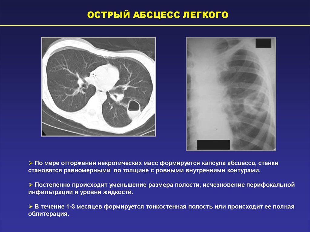 Рентгенологическая картина при абсцессе