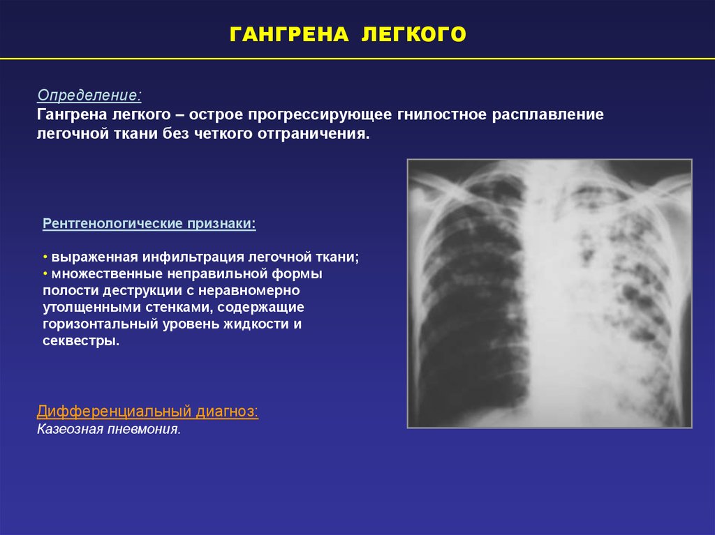 Гангрена легкого рисунок