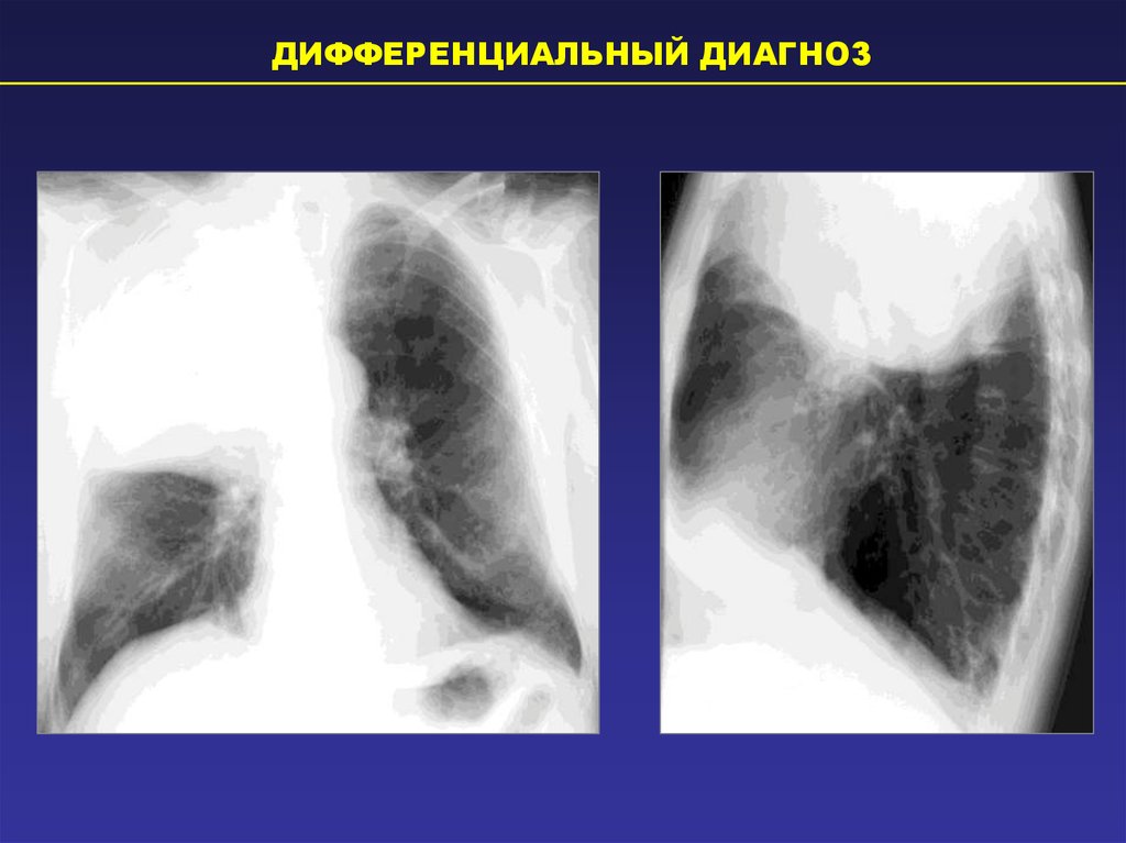 Перисциссурит рентген картина