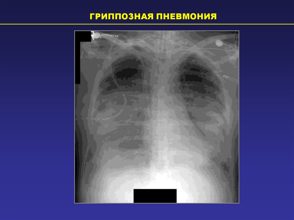 Картина пневмонии. Рентгенодиагностика заболеваний легких. Вирусная пневмония рентген. Септическая пневмония на рентгенограмме. Септическая пневмония рентген.